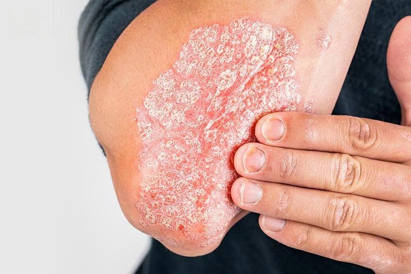 Đề xuất tăng mức chi trả bảo hiểm y tế cho thuốc sinh học điều trị vảy nến