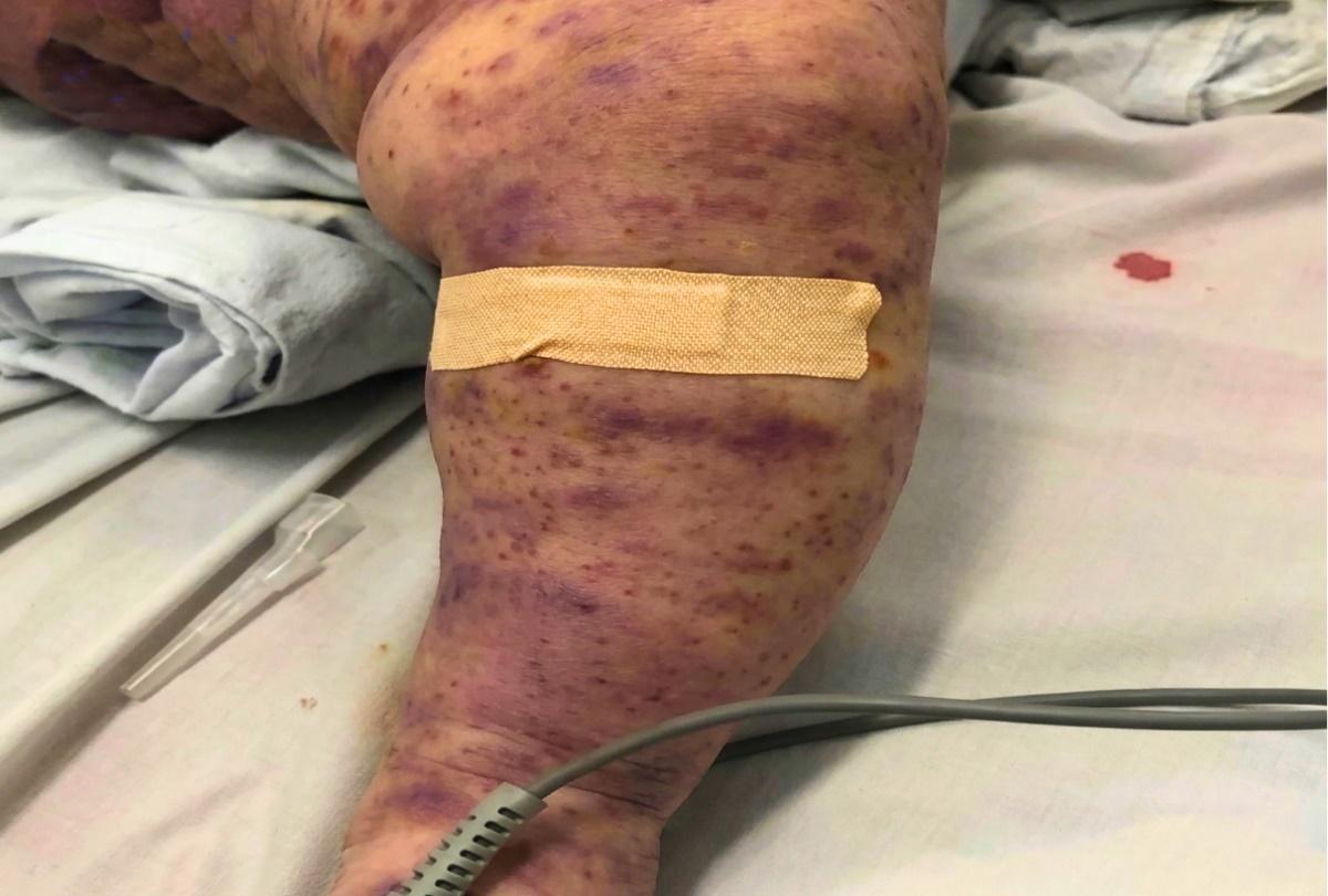 24 ca mắc, 4 ca tử vong, gây tử vong trong 24 giờ: Bác sĩ BV Bạch Mai phát cảnh báo 'nóng' về căn bệnh nguy hiểm 24 ca mắc, 4 ca tử vong, gây tử vong trong 24 giờ: Bác sĩ BV Bạch Mai phát cảnh báo 'nóng' về căn bệnh nguy hiểm