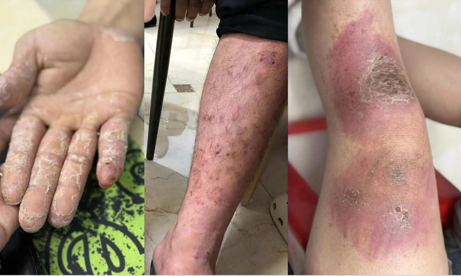 Bác sĩ lưu ý những bệnh dễ mắc sau ngập úng