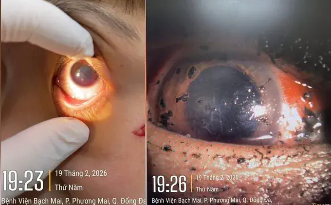 Nhiều ca chấn thương mắt nặng, chủ yếu ở trẻ em do pháo dịp Tết