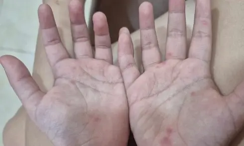 Cảnh báo chủng virus EV71 khiến trẻ mắc tay chân miệng chuyển nặng sau 24 giờ