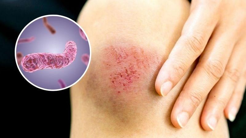 Bệnh Whitmore gia tăng tại Thái Lan, Bộ Y tế khuyến cáo người dân phòng ngừa