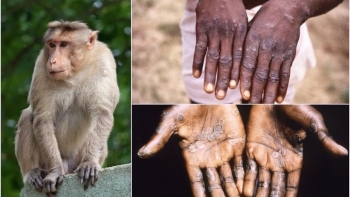 Sẵn sàng 3 kịch bản ứng phó với dịch đậu mùa khỉ