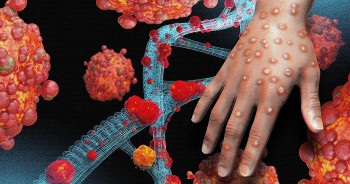 Chủ động kiểm soát, phòng, chống dịch bệnh đậu mùa khỉ