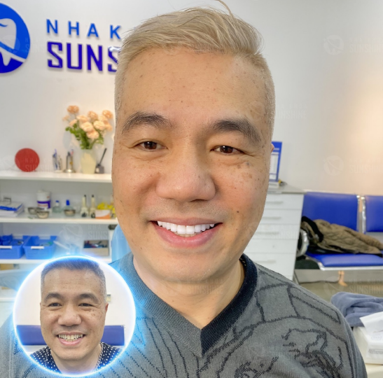 Phương pháp thẩm mỹ khắc phục mọi khuyết điểm về răng khi có dấu hiệu lão hoá.