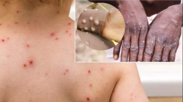 Những triệu chứng điển hình của bệnh đậu mùa khỉ