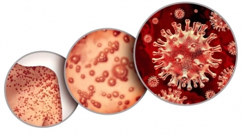 Các đường lây bệnh đậu mùa khỉ từ người sang người