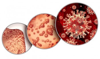 Các đường lây bệnh đậu mùa khỉ từ người sang người