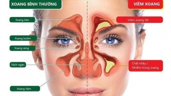 Bạn cần biết gì về bệnh viêm xoang