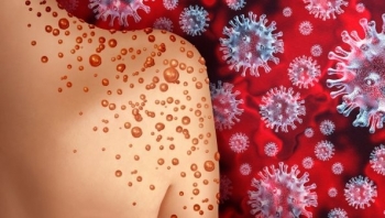 Có thể bạn chưa biết: Người nhiễm HIV mắc đậu mùa khỉ có nguy cơ tử vong rất cao