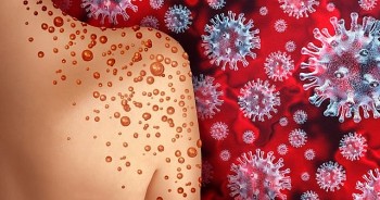 Có thể bạn chưa biết: Người nhiễm HIV mắc đậu mùa khỉ có nguy cơ tử vong rất cao