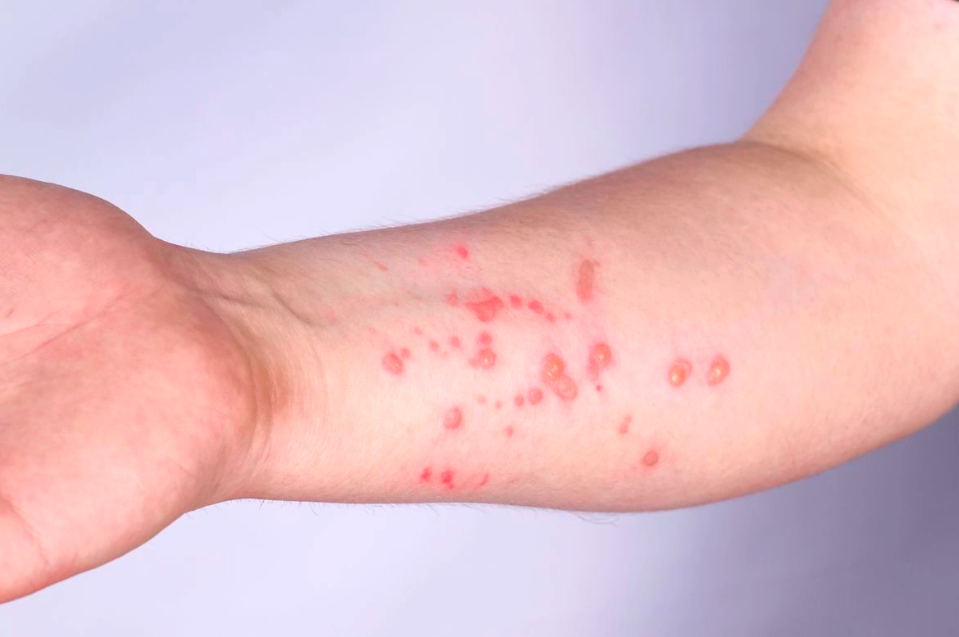 Bộ Y tế quyết định xếp bệnh đậu mùa khỉ vào bệnh truyền nhiễm nhóm B