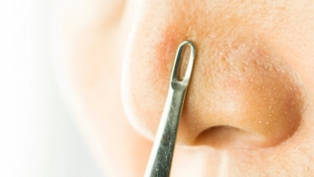 Bật mí cách làm mặt nạ giúp đẹp da, trị mụn đầu đen an toàn tại nhà