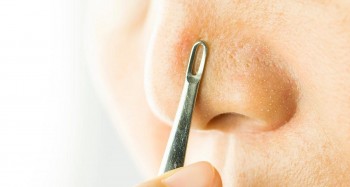 Bật mí cách làm mặt nạ giúp đẹp da, trị mụn đầu đen an toàn tại nhà