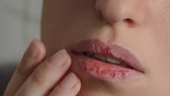 8 loại thảo dược là "khắc tinh" của da khô ráp, nứt nẻ