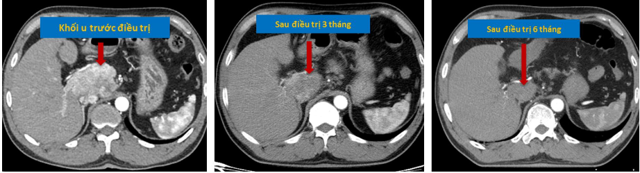 Khối u gan đáp ứng hoàn toàn sau xạ trị SBRT - Nguồn: Khoa Xạ trị - Xạ phẫu, Bệnh viện TƯQĐ 108 Khối u gan đáp ứng hoàn toàn sau xạ trị SBRT - Nguồn: Khoa Xạ trị - Xạ phẫu, Bệnh viện TƯQĐ 108