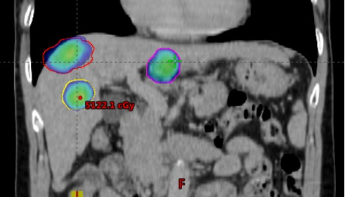 Xạ trị SBRT điều trị đồng thời 3 khối u gan - Nguồn: Khoa Xạ trị - Xạ phẫu, Bệnh viện TƯQĐ 108 Xạ trị SBRT điều trị đồng thời 3 khối u gan - Nguồn: Khoa Xạ trị - Xạ phẫu, Bệnh viện TƯQĐ 108
