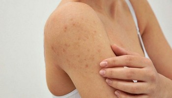 Khắc phục triệu chứng viêm nang lông với những nguyên liệu cực đơn giản