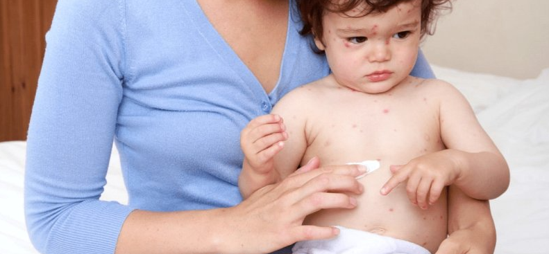 Sởi, thủy đậu - bệnh truyền nhiễm thường gặp ở trẻ em, cần làm gì để phòng bệnh?