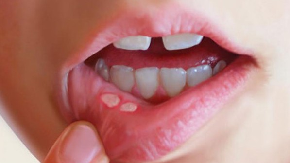 Nhiệt miệng nên ăn gì? Những thực phẩm, món ăn giúp nhiệt miệng nhanh khỏi, có loại ít người biết