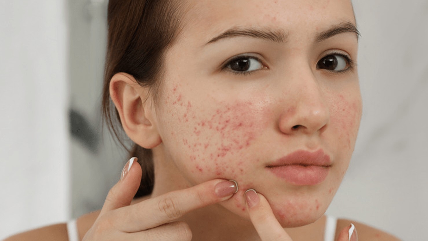 Các vị trí mụn trên mặt và cảnh báo tình trạng sức khỏe