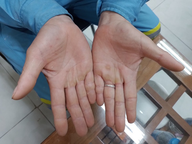 đôi bàn tay sứt sẹo, chai sần theo năm tháng