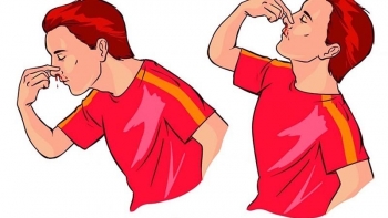 Cách xử trí chảy máu cam đúng nhất