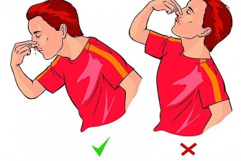 Cách xử trí chảy máu cam đúng nhất