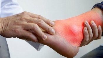 Người bị bệnh gút cần tránh những thực phẩm nào?