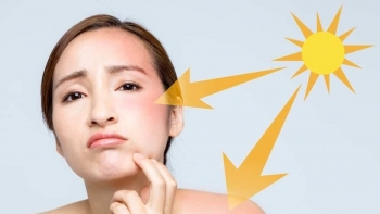 Cách giảm bỏng rát khi da bị cháy nắng trong mùa hè