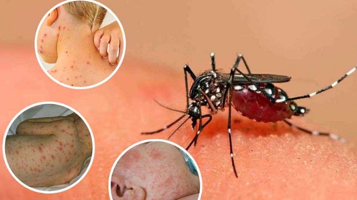 Tăng cường phòng các bệnh mùa hè có thể bùng phát thành dịch lớn