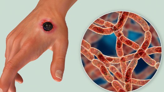 Bệnh than có nguy hiểm không?