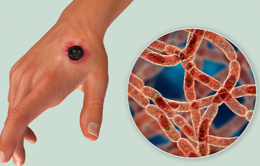 Bệnh than có nguy hiểm không?