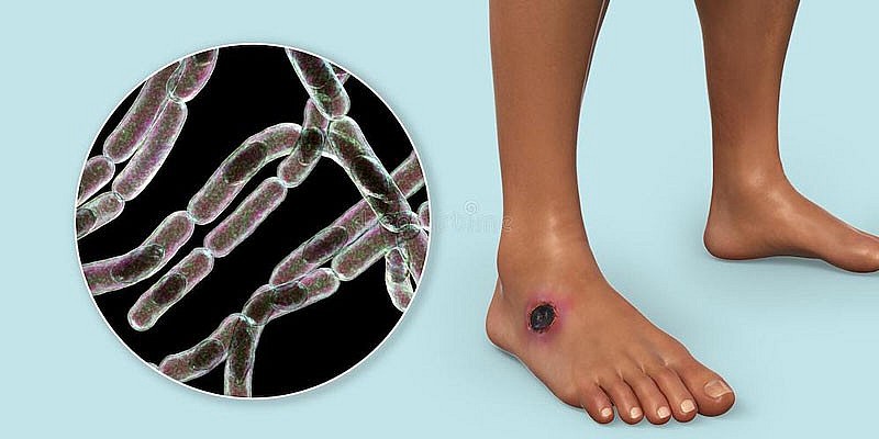 Bệnh than gây ra bởi loại vi khuẩn gram dương, hình que Bacillus anthracis