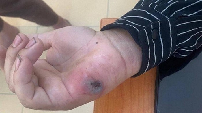 Dấu hiệu bệnh than trên tay 1 bệnh nhân ở Điện Biên
