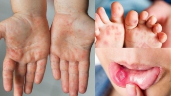 Tăng cường phòng chống dịch tay chân miệng tại các địa phương