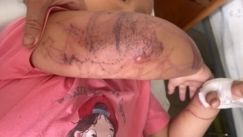 Bị sứa đốt khi tắm biển, bé gái 7 tuổi nhập viện cấp cứu trong tình trạng mất ý thức