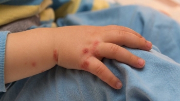 Chuyên gia hướng dẫn chăm sóc trẻ bị tay chân miệng đúng cách