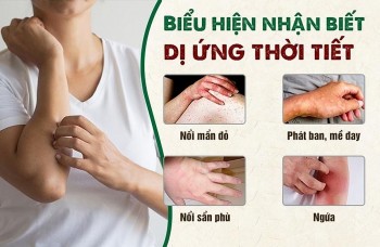 Cách phòng ngừa phát ban nhiệt mùa hè đơn giản tại nhà