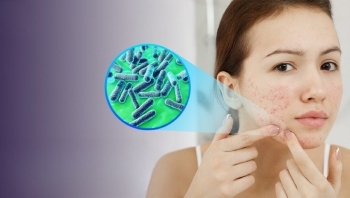 Review 2 loại kem hỗ trợ giảm mụn mà dân dành skincare không thể bỏ qua