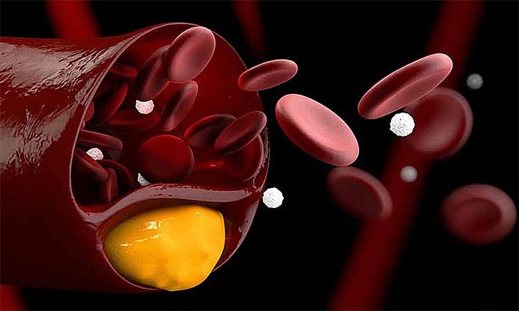 Mỡ máu cao hay máu nhiễm mỡ là tình trạng dư thừa mỡ ở trong máu