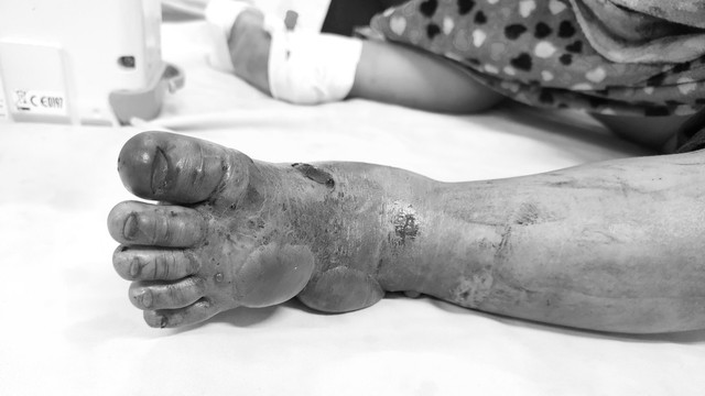 Bé 2 tuổi ở Tuyên Quang bị rắn hổ mang bò lên giường cắn nguy kịch