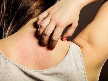 Cách trị ngứa bằng những bài thuốc dân gian