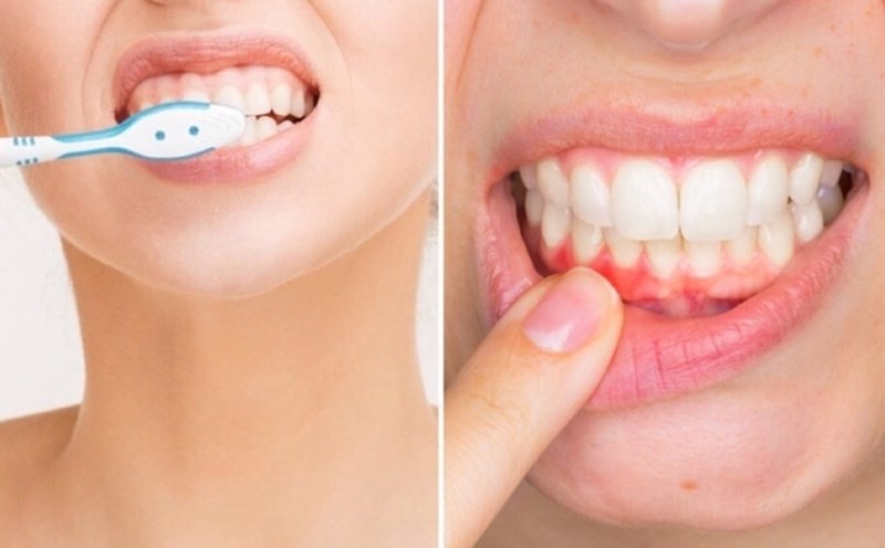 Những ai không không nên tẩy trắng răng 