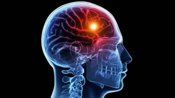 Thiếu oxy lên não, bệnh lý nguy hiểm nếu không được kiểm soát