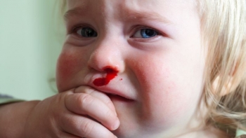 Mách bố mẹ cách xử trí khi trẻ bị chảy máu cam tại nhà
