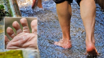 Những cách chữa nước ăn chân mùa mưa tại nhà hiệu quả