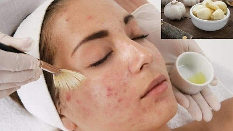 7 lợi ích của dầu tỏi với sức khỏe 7 lợi ích của dầu tỏi với sức khỏe