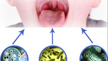 Nguyên nhân gây đau họng vào buổi sáng