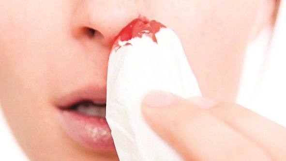 Biến chứng chảy máu mũi khi mắc sốt xuất huyết